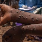 RDC : Après trois ans de lutte, l&rsquo;épidémie de Mpox n&rsquo;est plus une urgence nationale